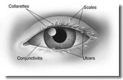 Blepharitis eye disorder.