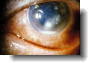 corneal ulcer symptoms and treatment