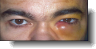 dacryocystitis tear duct and sac eye infection