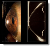 keratoconus eye disorder symtoms treatment