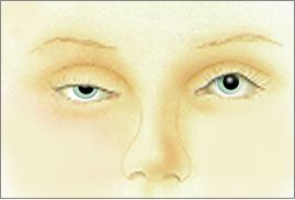 ptosis drooping eyelid disorder