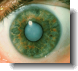 a typical eye cataract